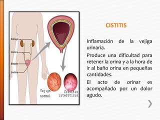 CISTITIS 
Inflamación de la vejiga 
urinaria. 
Produce una dificultad para 
retener la orina y a la hora de 
ir al baño orina en pequeñas 
cantidades. 
El acto de orinar es 
acompañado por un dolor 
agudo. 
 