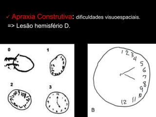ü Apraxia Construtiva: dificuldades visuoespaciais.
=> Lesão hemisfério D.
 