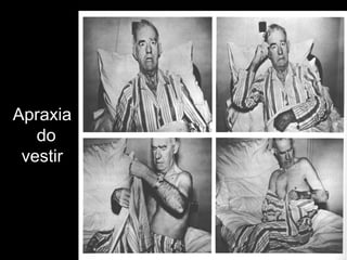 Apraxia
do
vestir
Lesão Hem.D
 