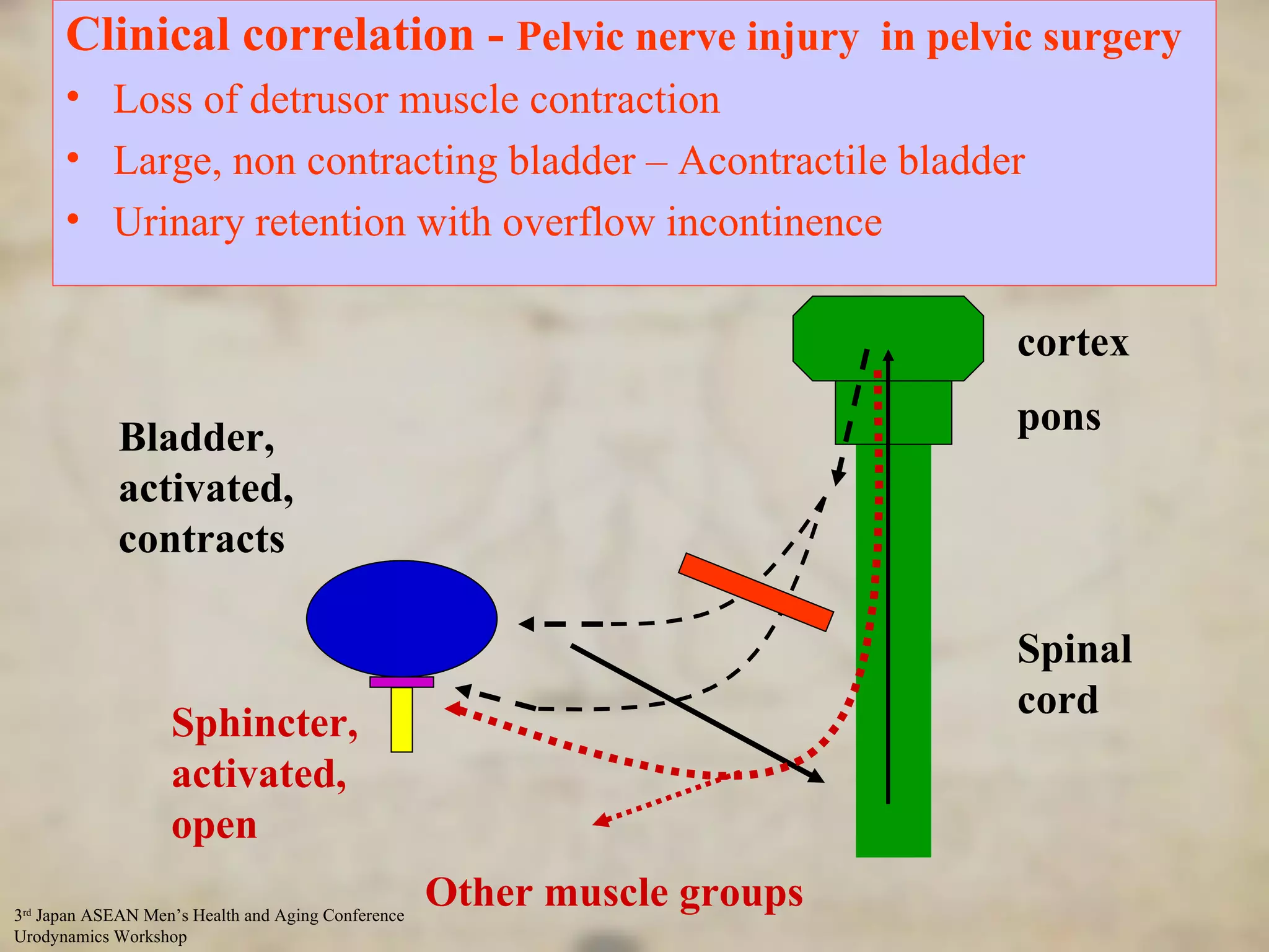 Control of Micturation - input from higher centres Sphincter, activated, open Bladder, activated, contracts cortex pons Spinal cord Other muscle groups Clinical correlation -  Pelvic nerve injury  in pelvic surgery Loss of detrusor muscle contraction Large, non contracting bladder – Acontractile bladder Urinary retention with overflow incontinence 