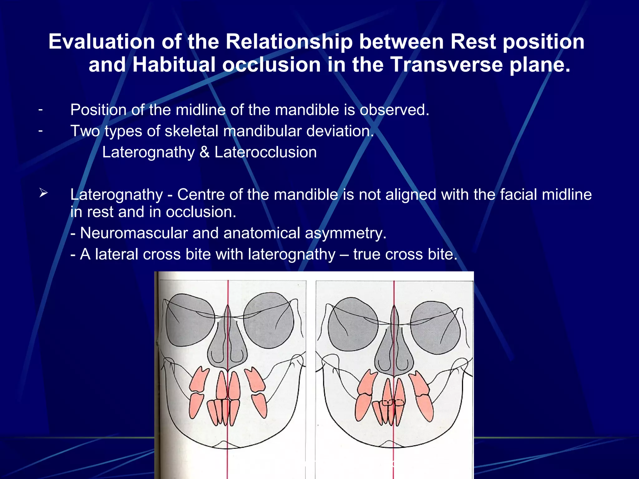 Evaluation of the Relationship between Rest position
and Habitual occlusion in the Transverse plane.
-



Position of the midline of the mandible is observed.
Two types of skeletal mandibular deviation.
Laterognathy & Laterocclusion
Laterognathy - Centre of the mandible is not aligned with the facial midline
in rest and in occlusion.
- Neuromascular and anatomical asymmetry.
- A lateral cross bite with laterognathy – true cross bite.

www.indiandentalacademy.com

 