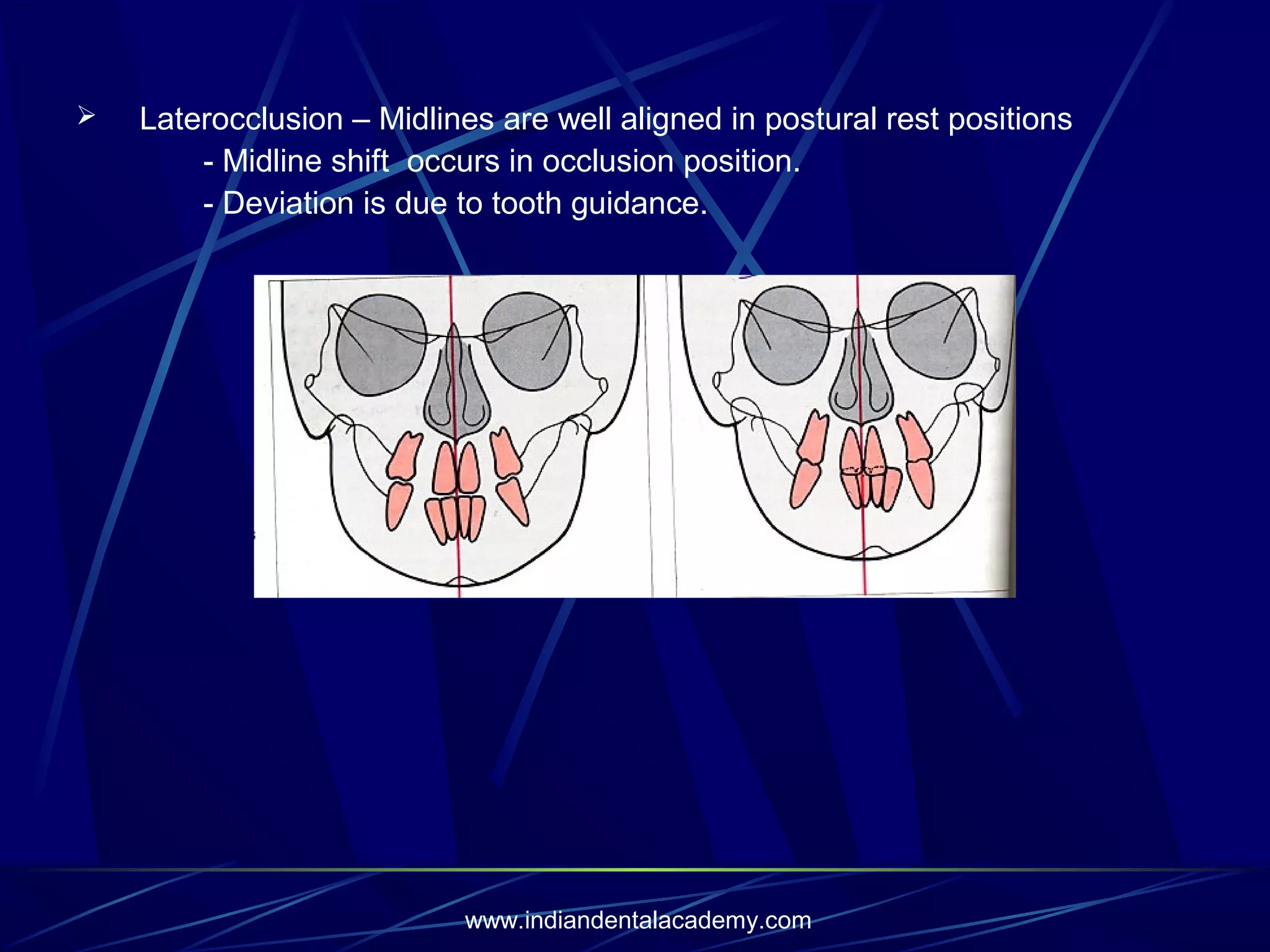 

Laterocclusion – Midlines are well aligned in postural rest positions
- Midline shift occurs in occlusion position.
- Deviation is due to tooth guidance.

www.indiandentalacademy.com

 