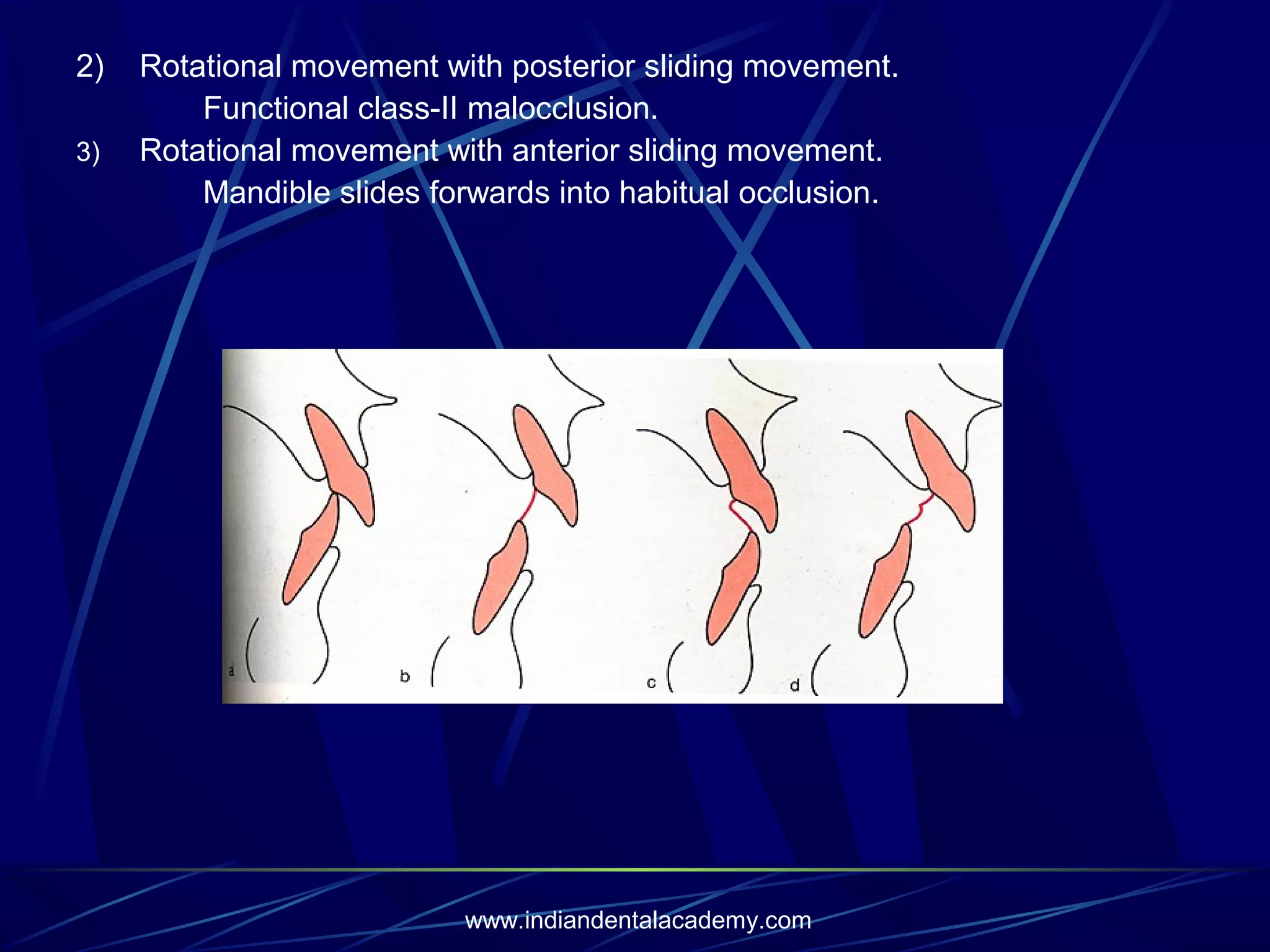 2)
3)

Rotational movement with posterior sliding movement.
Functional class-II malocclusion.
Rotational movement with anterior sliding movement.
Mandible slides forwards into habitual occlusion.

www.indiandentalacademy.com

 