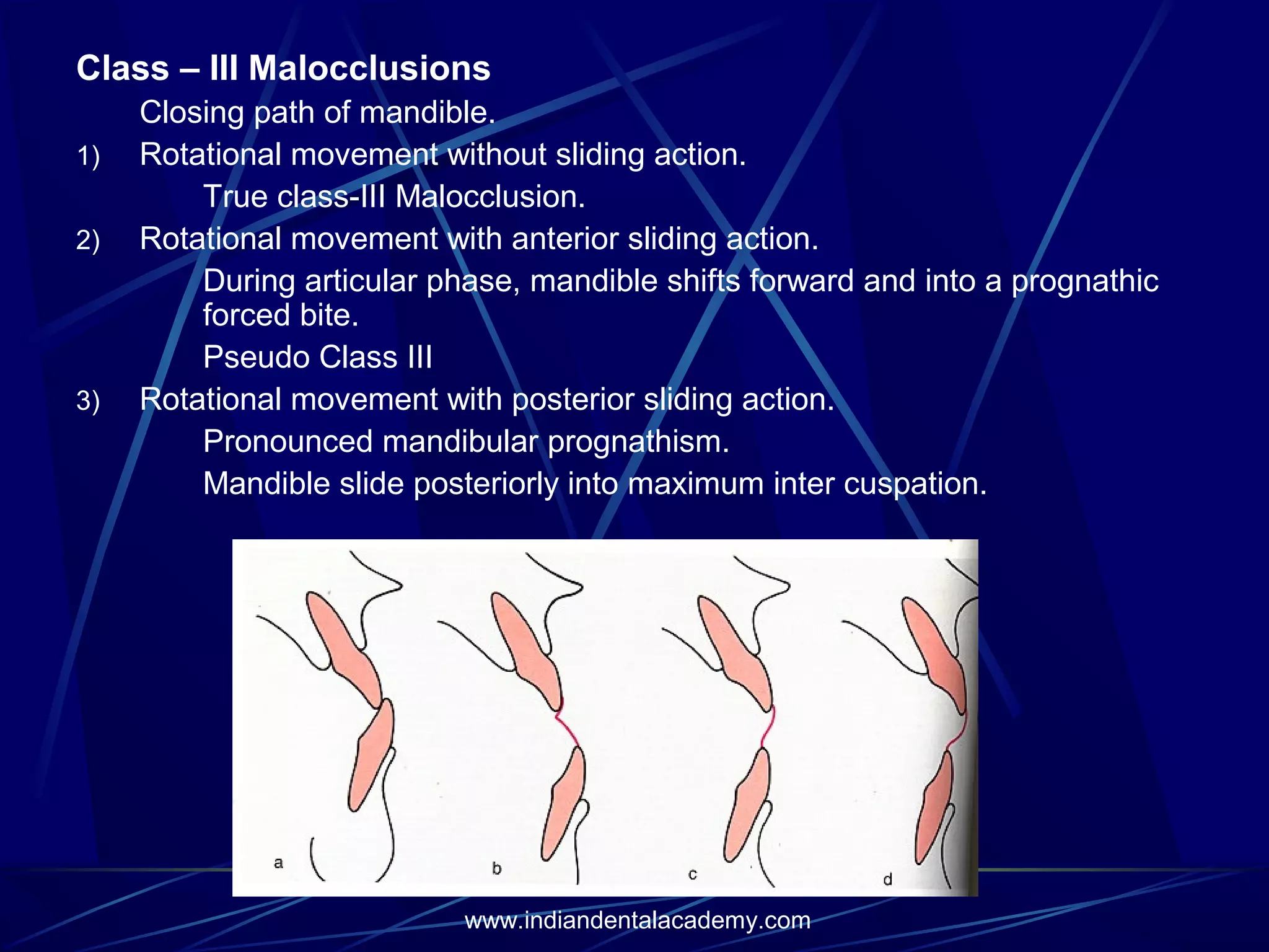 Class – III Malocclusions
1)
2)

3)

Closing path of mandible.
Rotational movement without sliding action.
True class-III Malocclusion.
Rotational movement with anterior sliding action.
During articular phase, mandible shifts forward and into a prognathic
forced bite.
Pseudo Class III
Rotational movement with posterior sliding action.
Pronounced mandibular prognathism.
Mandible slide posteriorly into maximum inter cuspation.

www.indiandentalacademy.com

 