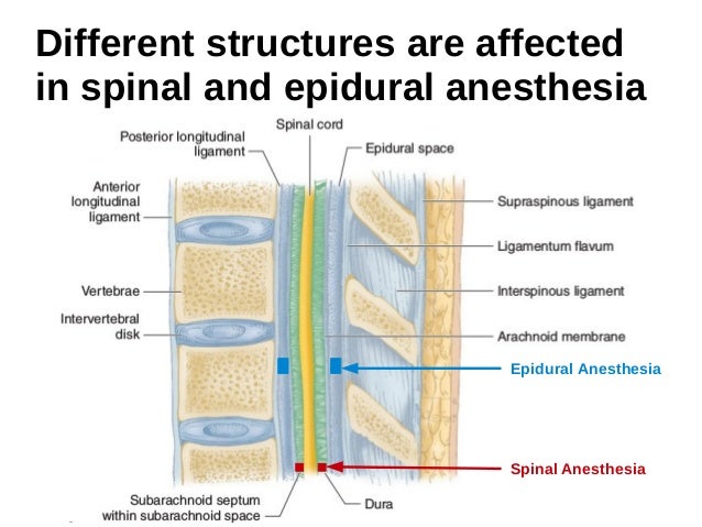 Bildresultat fÃ¶r Spinal Anesthesia