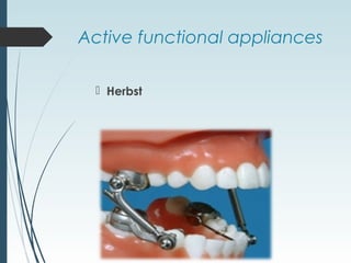 Active functional appliances
 Herbst
 