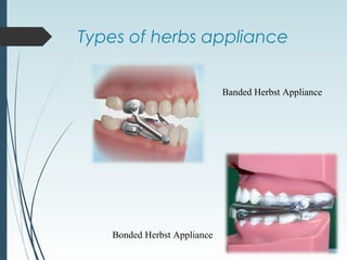 Types of herbs appliance
Banded Herbst Appliance
Bonded Herbst Appliance
 