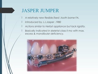 JASPER JUMPER
 A relatively new flexible,fixed ,tooth borne FA.
 Introduced by J.J.Jasper ,1980
 Actions similar to Herbst appliance but lack rigidity.
 Basically indicated in skeletal class II mo with max.
excess & mandibular deficiency.
 