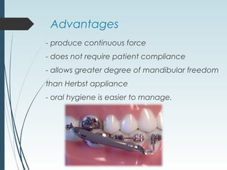 Advantages
- produce continuous force
- does not require patient compliance
- allows greater degree of mandibular freedom
than Herbst appliance
- oral hygiene is easier to manage.
 