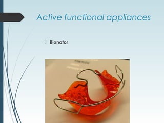 Active functional appliances
 Bionator
 