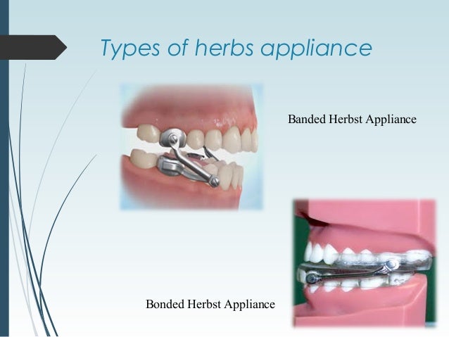 herbst appliance