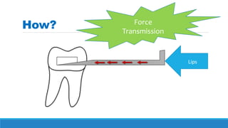How?
Lips
Force
Transmission
 