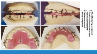 MandPosturingcomponent
Eruptionguidancecomponent
Retentivecomponent
Passivecomponent
Activecomponent
 