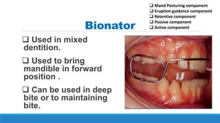 Bionator
 Used in mixed
dentition.
 Used to bring
mandible in forward
position .
 Can be used in deep
bite or to maintaining
bite.
 Mand Posturing component
 Eruption guidance component
 Retentive component
 Passive component
 Active component
 