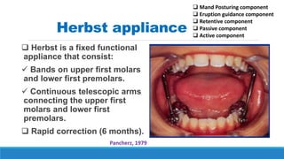 Herbst appliance
 Herbst is a fixed functional
appliance that consist:
 Bands on upper first molars
and lower first premolars.
 Continuous telescopic arms
connecting the upper first
molars and lower first
premolars.
 Rapid correction (6 months).
Pancherz, 1979
 Mand Posturing component
 Eruption guidance component
 Retentive component
 Passive component
 Active component
 
