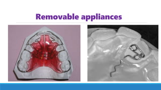 Removable appliances
 