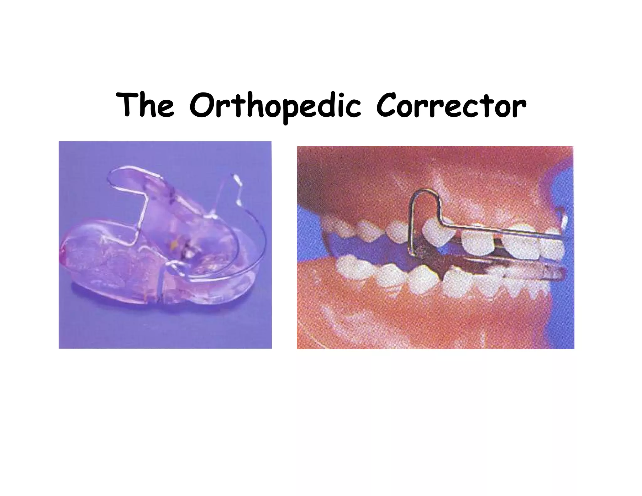 The Orthopedic Corrector
 