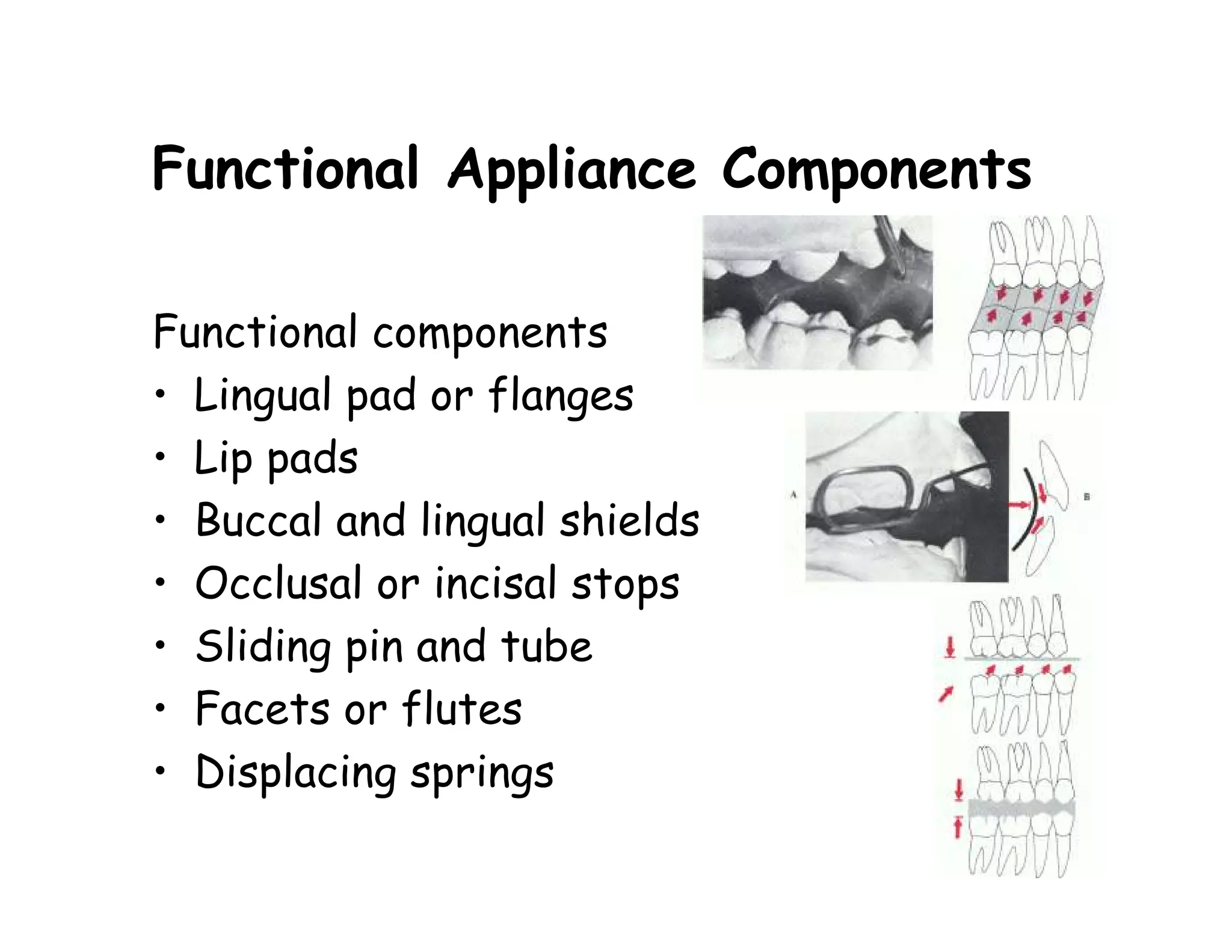 Functional Appliance Components

Functional components
• Lingual pad or flanges
• Lip pads
• Buccal and lingual shields
• Occlusal or incisal stops
• Sliding pin and tube
• Facets or flutes
• Displacing springs
 