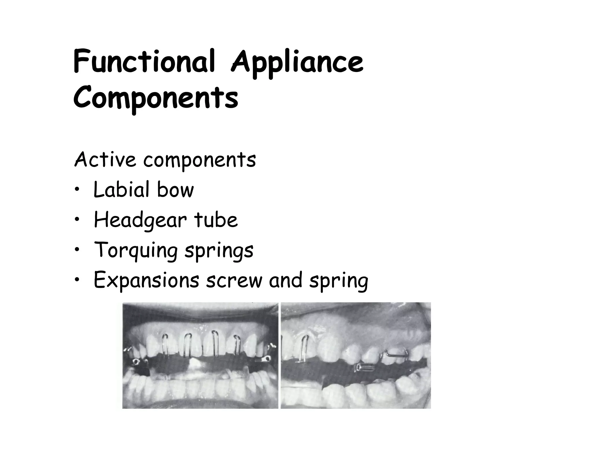 Functional Appliance
Components
Active components
• Labial bow
• Headgear tube
• Torquing springs
• Expansions screw and spring
 