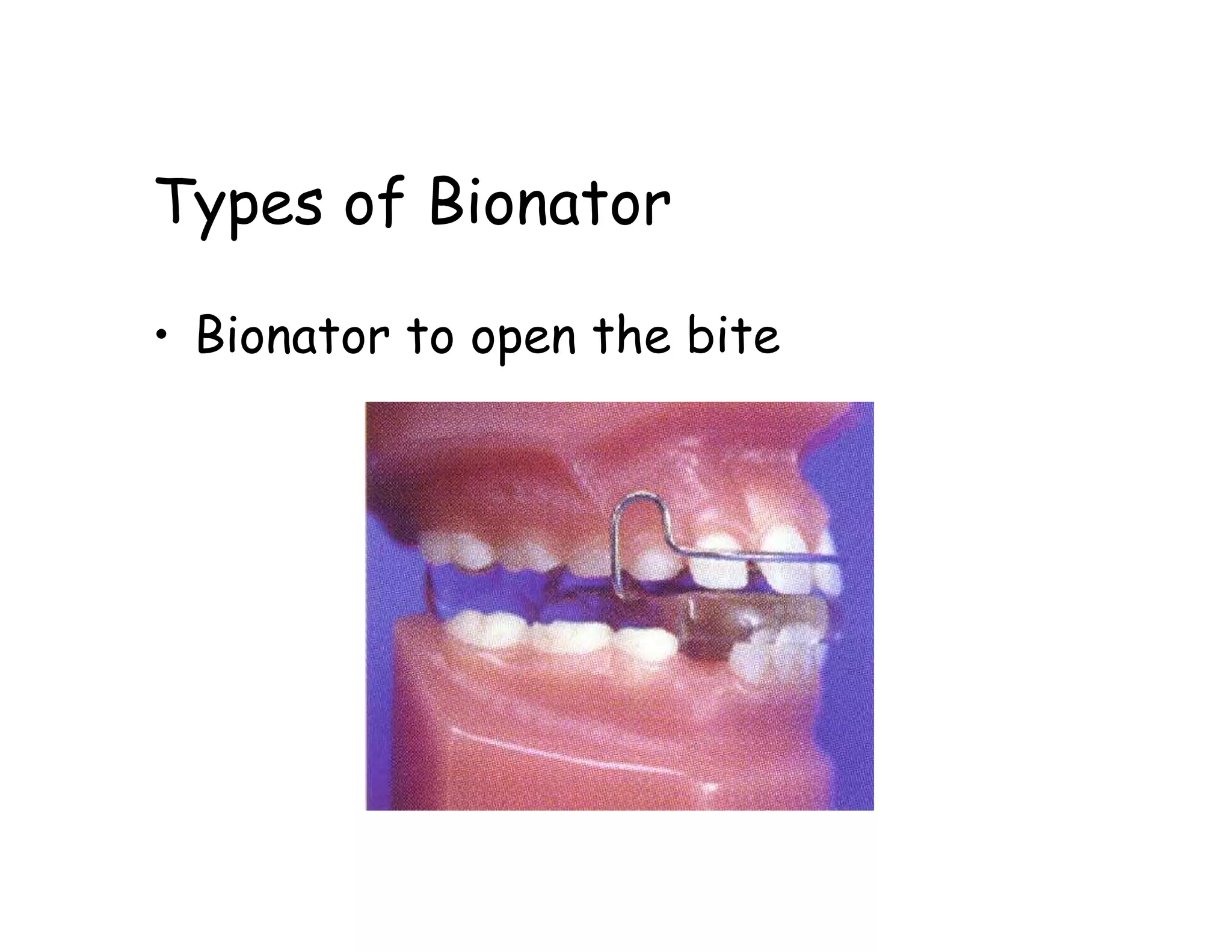 Types of Bionator

• Bionator to open the bite
 