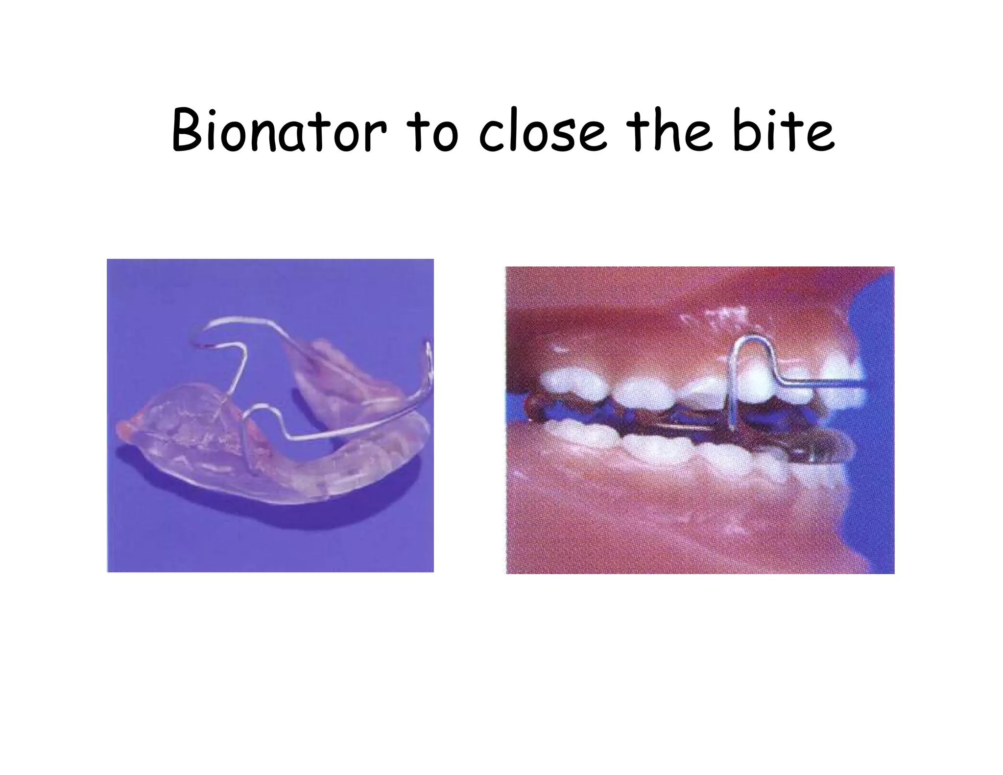 Bionator to close the bite
 