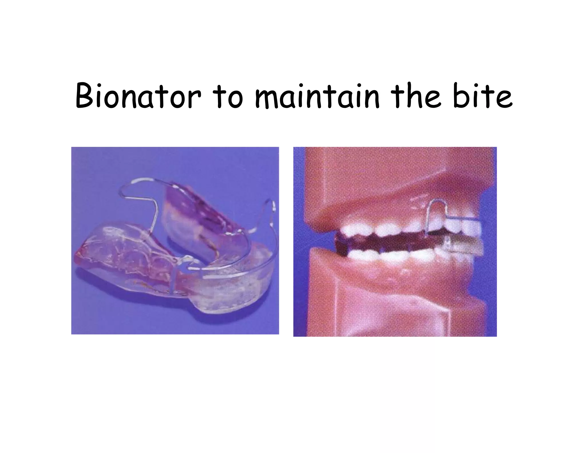 Bionator to maintain the bite
 