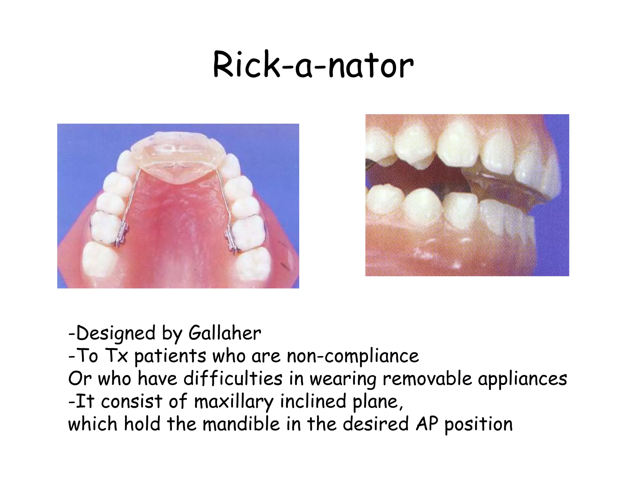 Rick-a-nator




-Designed by Gallaher
-To Tx patients who are non-compliance
Or who have difficulties in wearing removable appliances
-It consist of maxillary inclined plane,
which hold the mandible in the desired AP position
 
