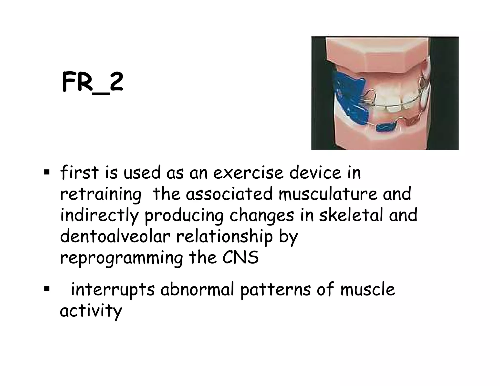 FR_2


first is used as an exercise device in
retraining the associated musculature and
indirectly producing changes in skeletal and
dentoalveolar relationship by
reprogramming the CNS
 interrupts abnormal patterns of muscle
activity
 