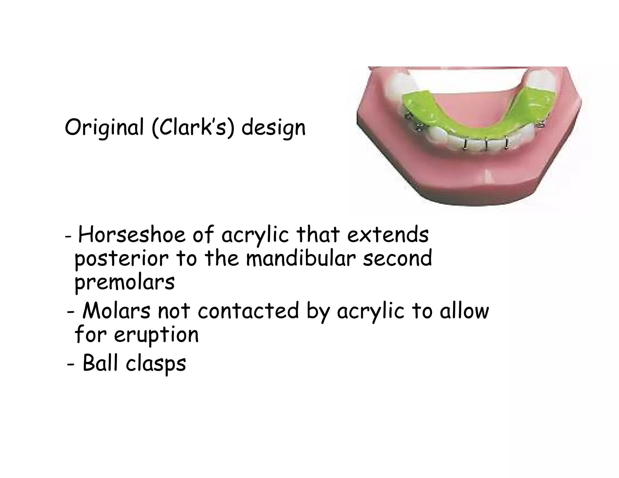 Original (Clark’s) design



- Horseshoe of acrylic that extends
 posterior to the mandibular second
 premolars
- Molars not contacted by acrylic to allow
 for eruption
- Ball clasps
 