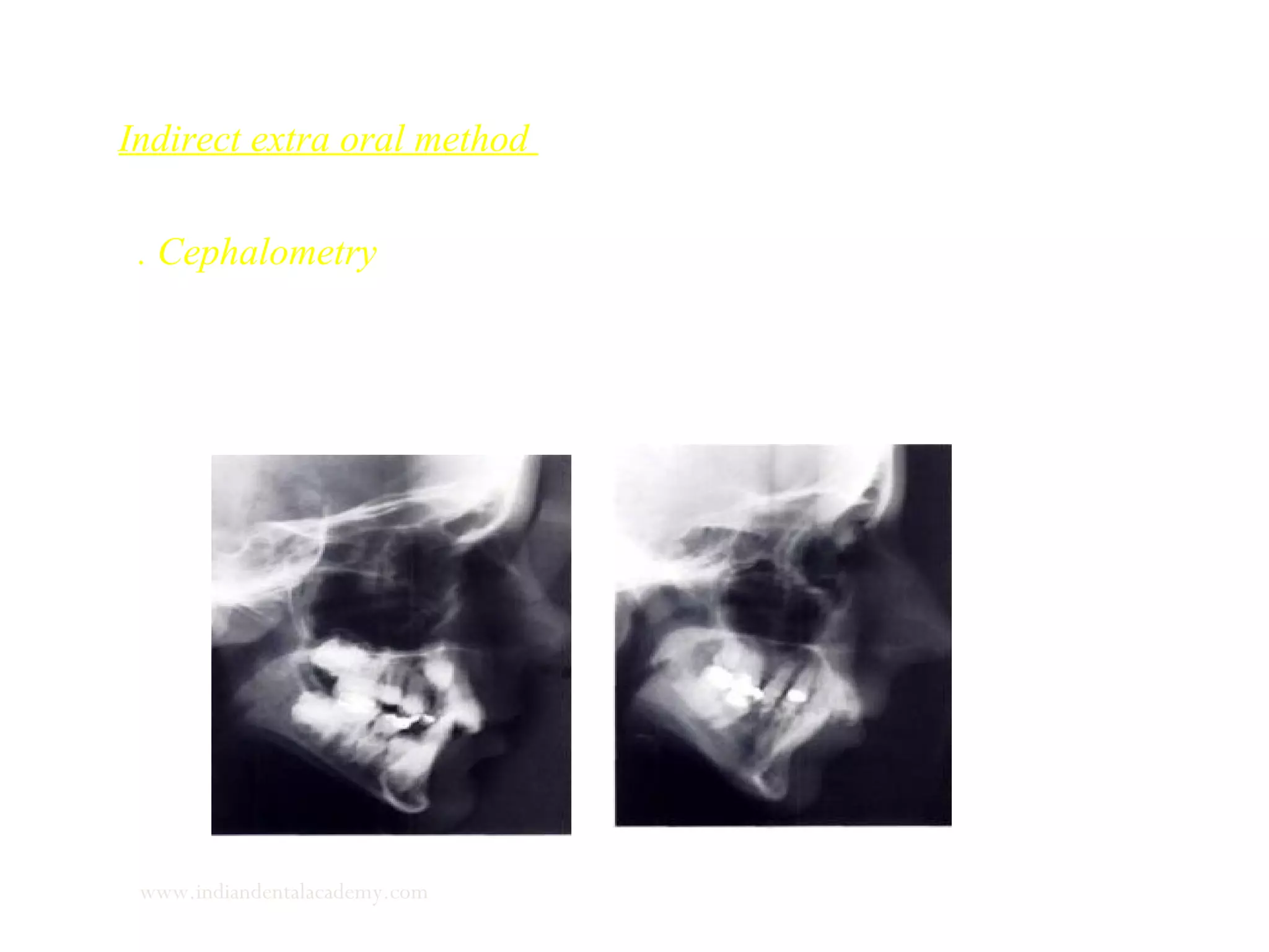 Indirect extra oral method
1. Cephalometry - the clinician takes two or three lateral cephalograms
under identical exposure and patient position conditions
www.indiandentalacademy.com
 
