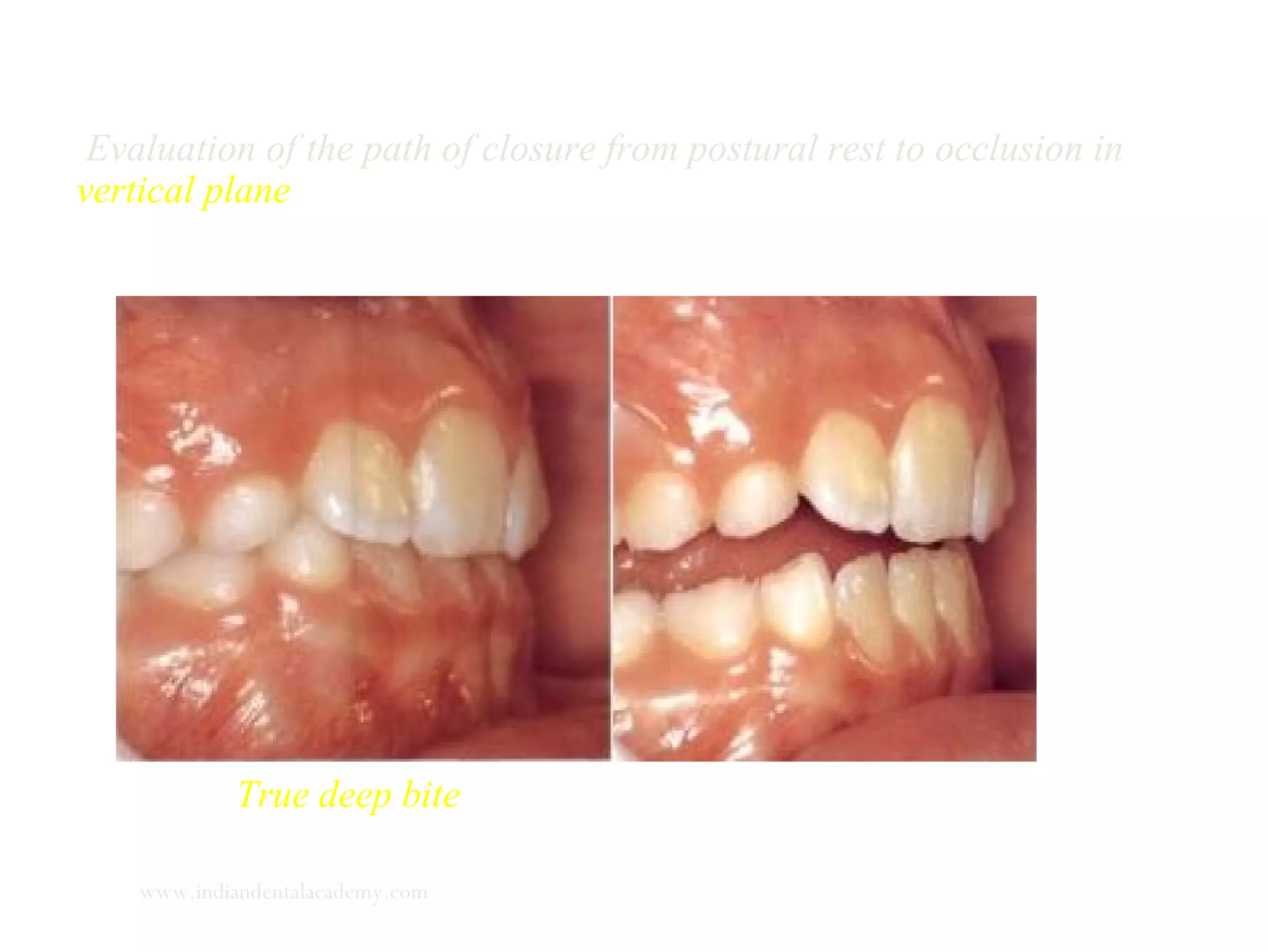 Evaluation of the path of closure from postural rest to occlusion in
vertical plane
True deep bite
www.indiandentalacademy.com
 