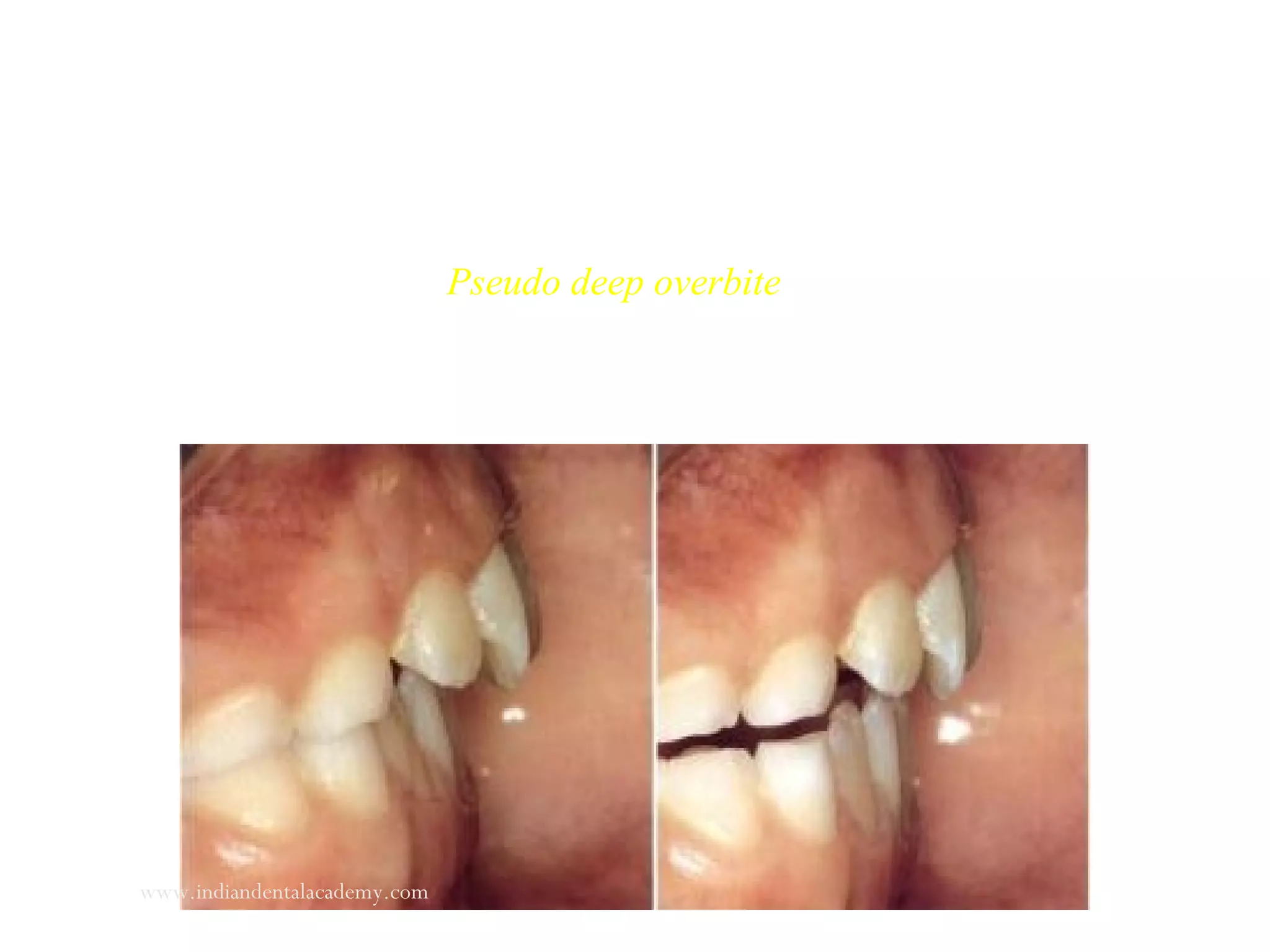 Pseudo deep overbite
www.indiandentalacademy.com
 