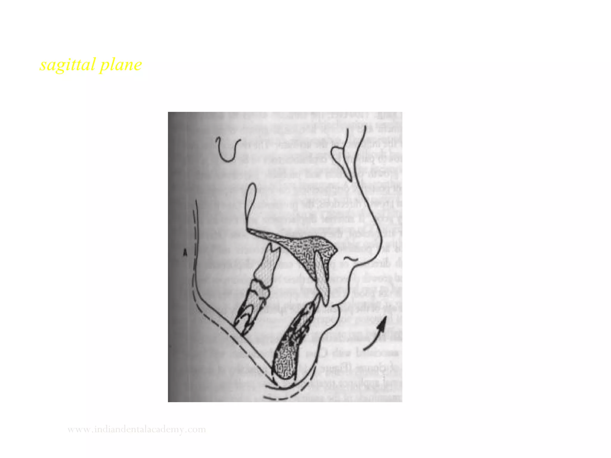 Evaluation of the path of closure from postural rest to occlusion in
sagittal plane
www.indiandentalacademy.com
 