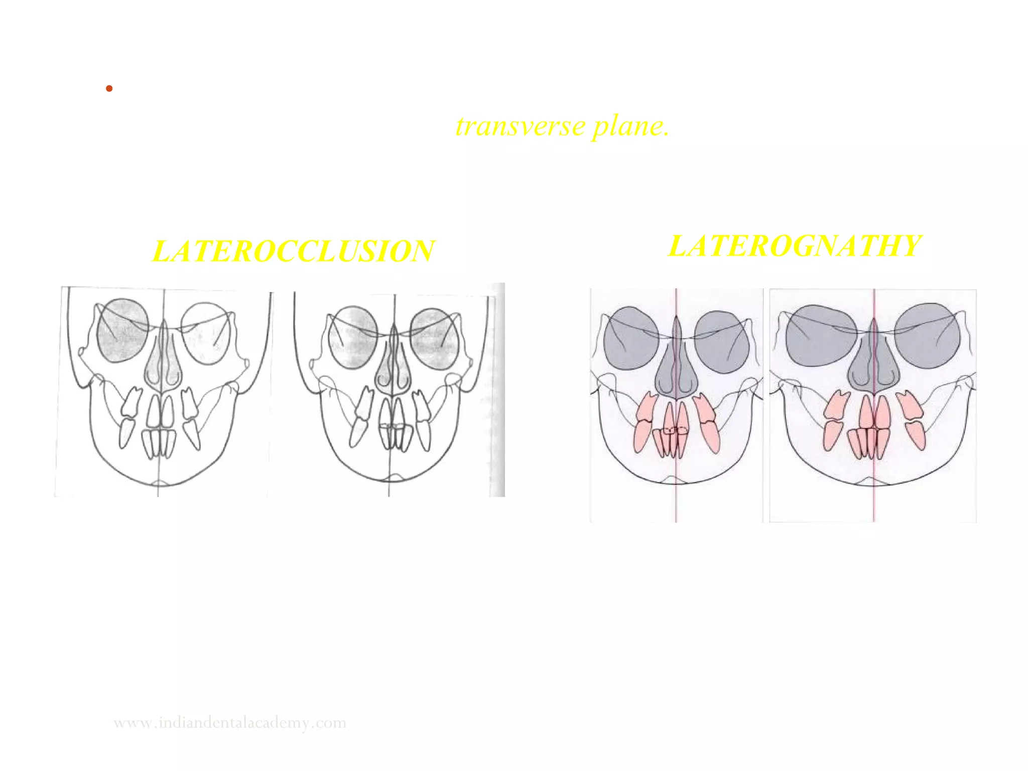 • Evaluation of the path of closure from postural rest to
habitual occlusion in the transverse plane.
LATEROCCLUSION LATEROGNATHY
www.indiandentalacademy.com
 