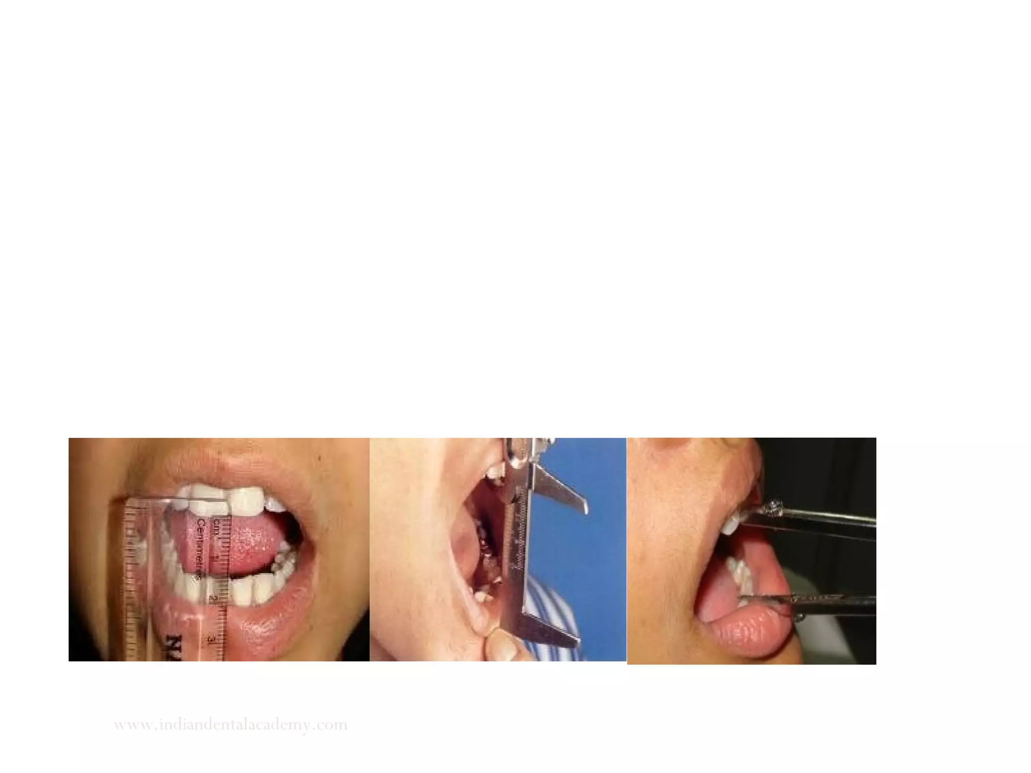 Maximum incisal distance
Normal range of mandibular opening when measured
interincisally is between 53 and 58 mm. The patient is asked to
open slowly until pain is first felt. This is the maximum
comfortable opening.
www.indiandentalacademy.com
 