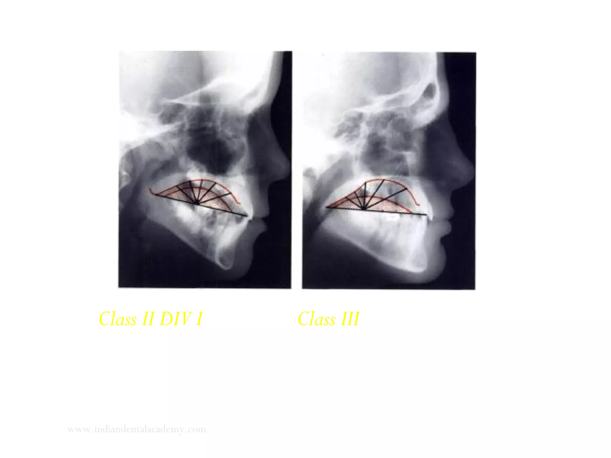 Class II DIV I (Left) Class III (Right)
www.indiandentalacademy.com
 