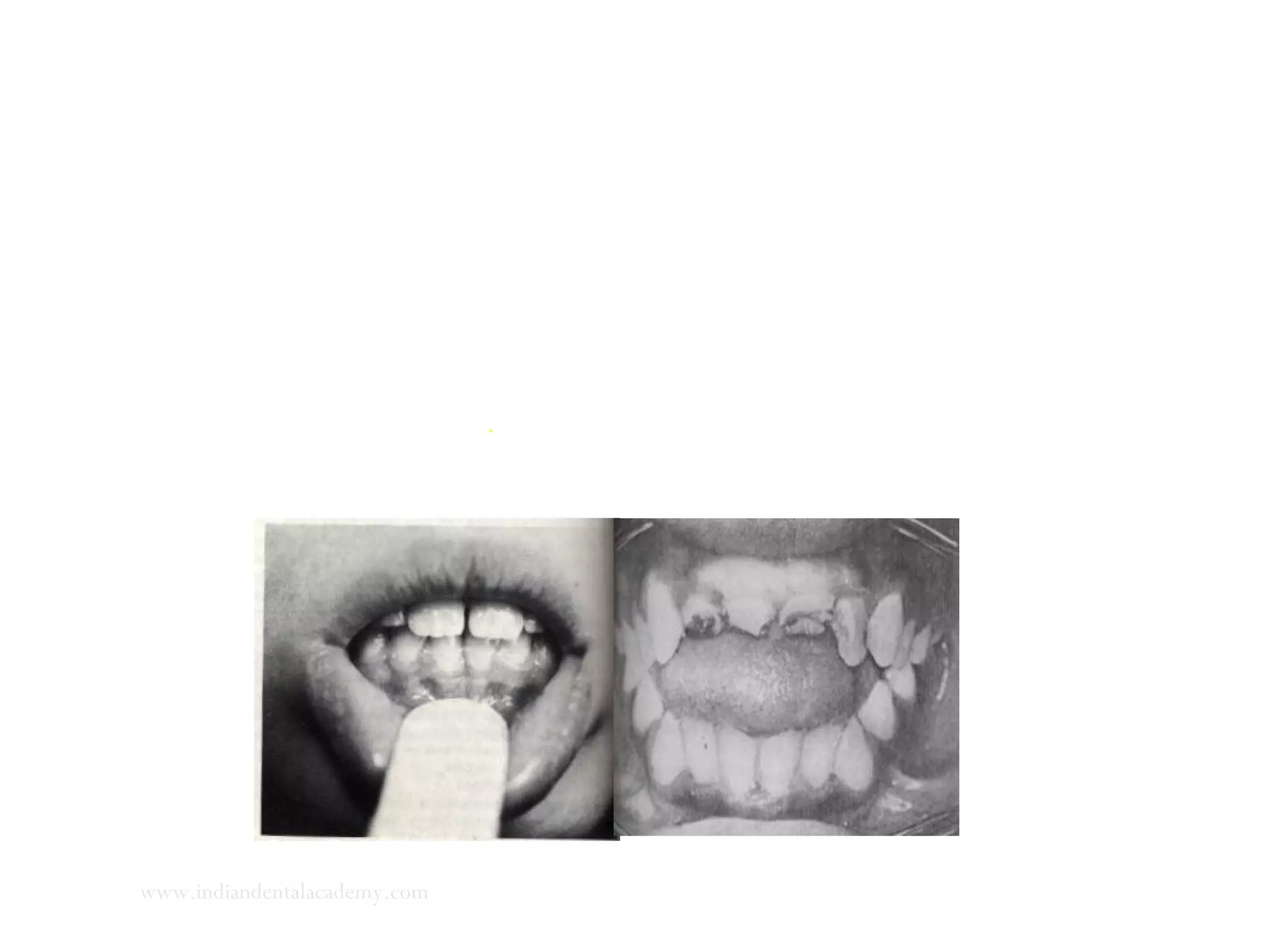 5. A tongue depressor or mouth mirror is placed on the lower lip to
hold it lightly. While the patient is asked to swallow.
6. Unconscious swallow may be examined more specifically as
follows.
Some more water is placed in the patents mouth and the hand on the temporal muscle. The patient is
asked to swallow for the last time.
www.indiandentalacademy.com
 