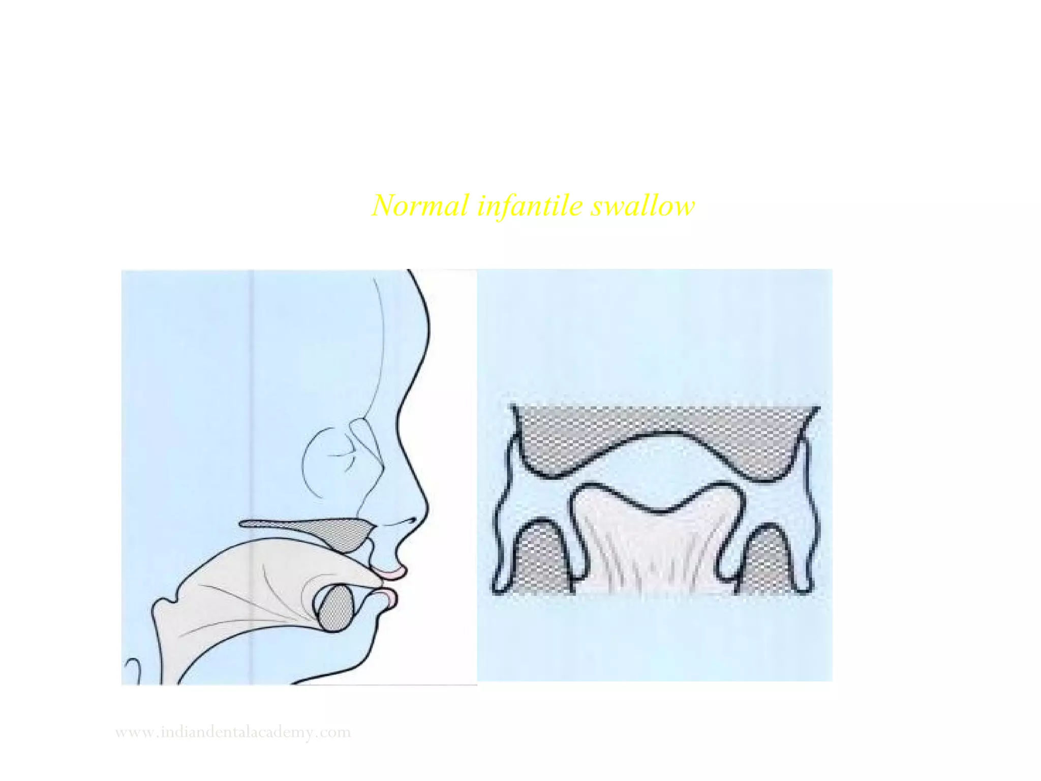 Normal infantile swallow
www.indiandentalacademy.com
 