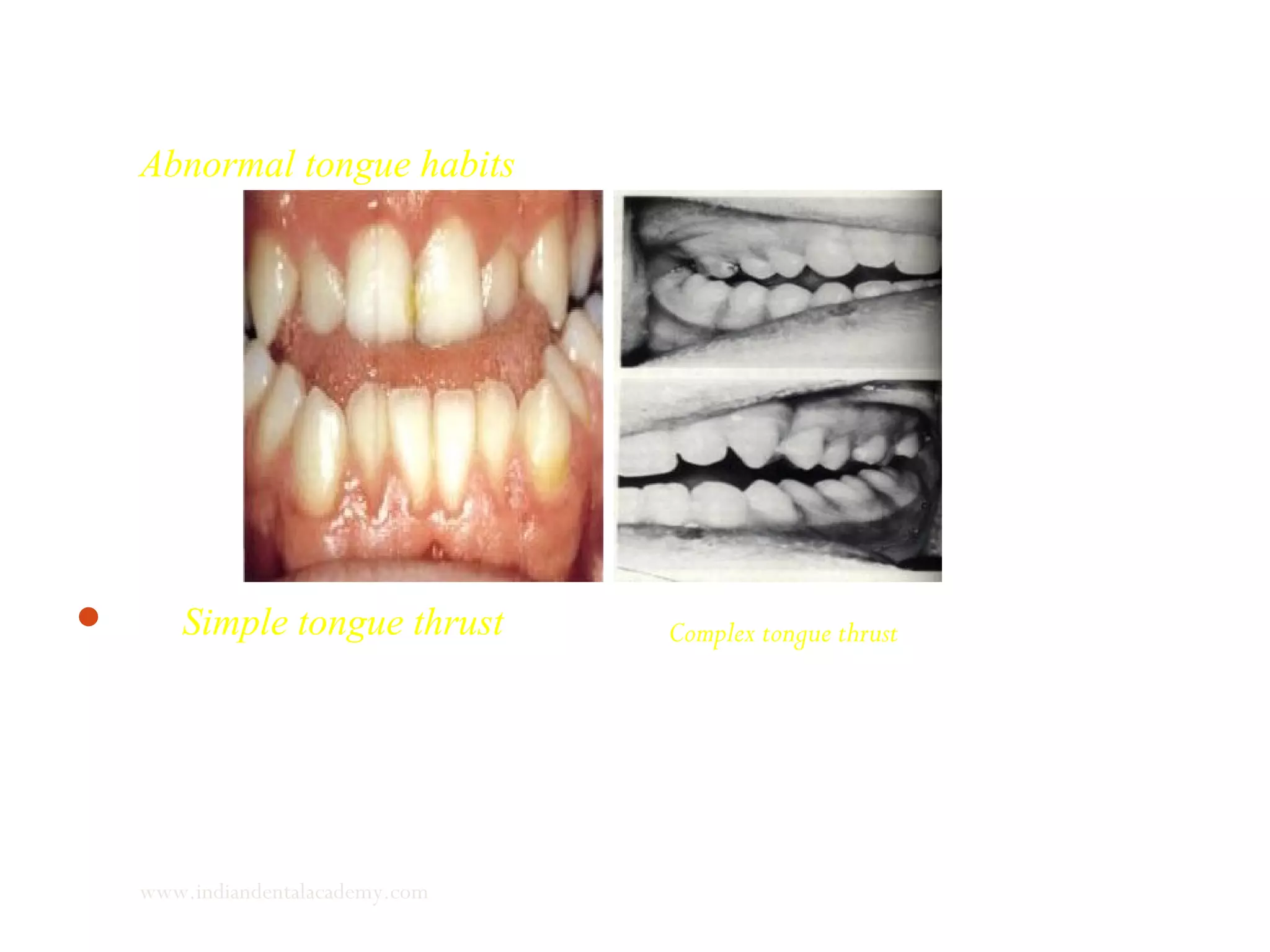 Abnormal tongue habits
 Simple tongue thrust Complex tongue thrust
www.indiandentalacademy.com
 