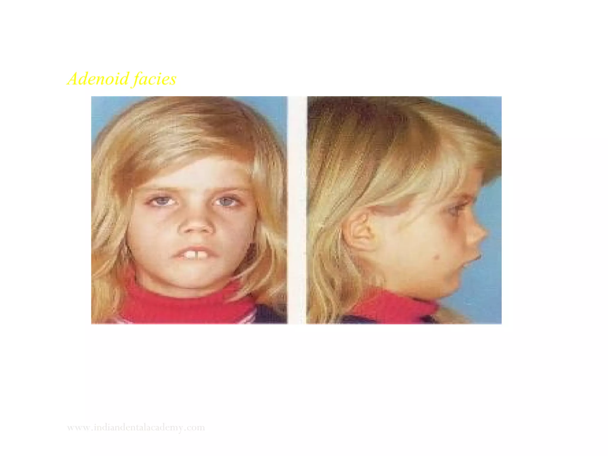 Adenoid facies
www.indiandentalacademy.com
 