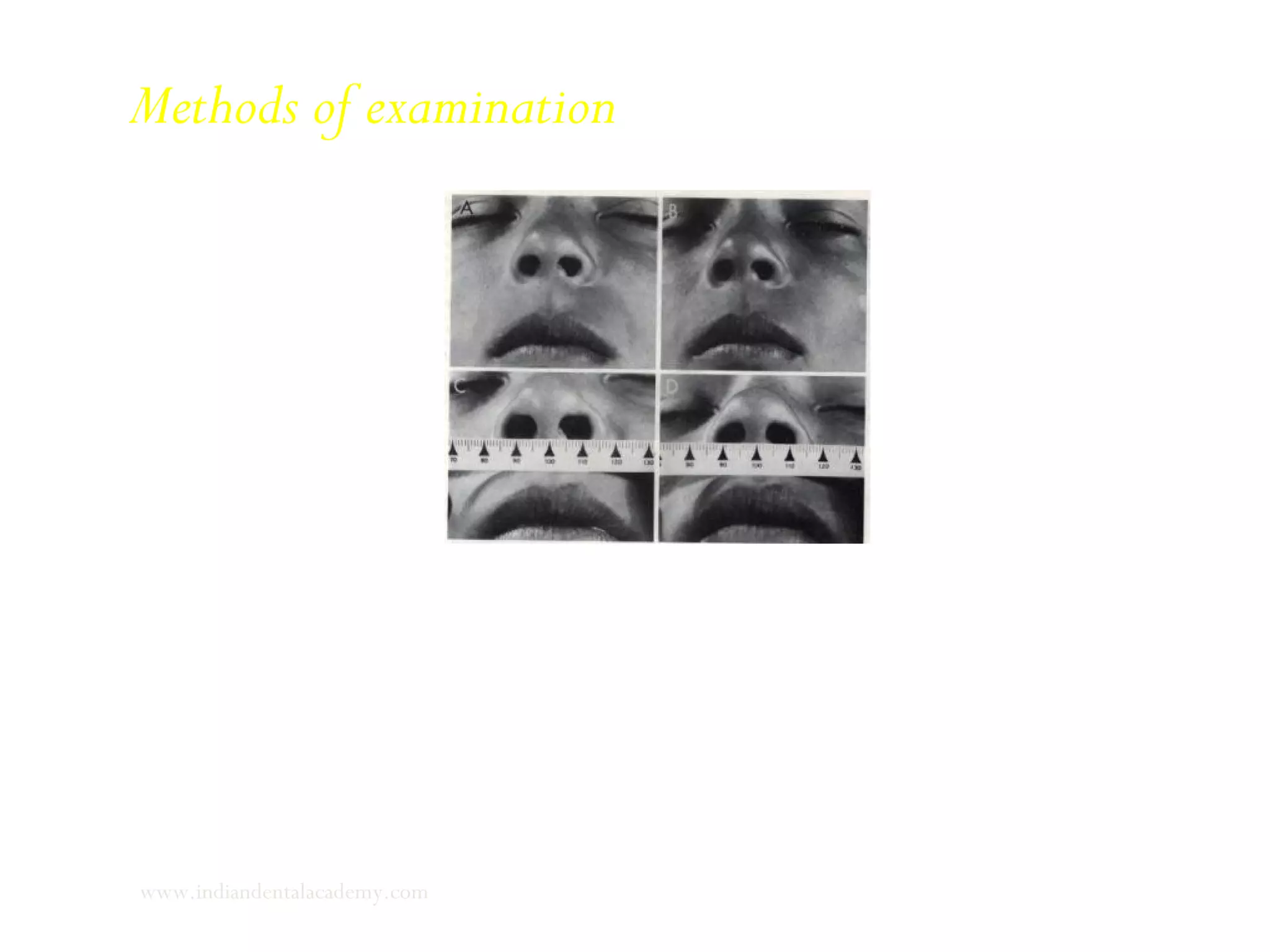 Mouth breathers do not change the shape or size of the external nares and occasionally contract the nasal
orifices on inspiration.
Even nasal breathers with temporary nasal congestion will demonstrate reflex alar contraction and dilation of
nares during voluntary inspiration.
Methods of examination
www.indiandentalacademy.com
 