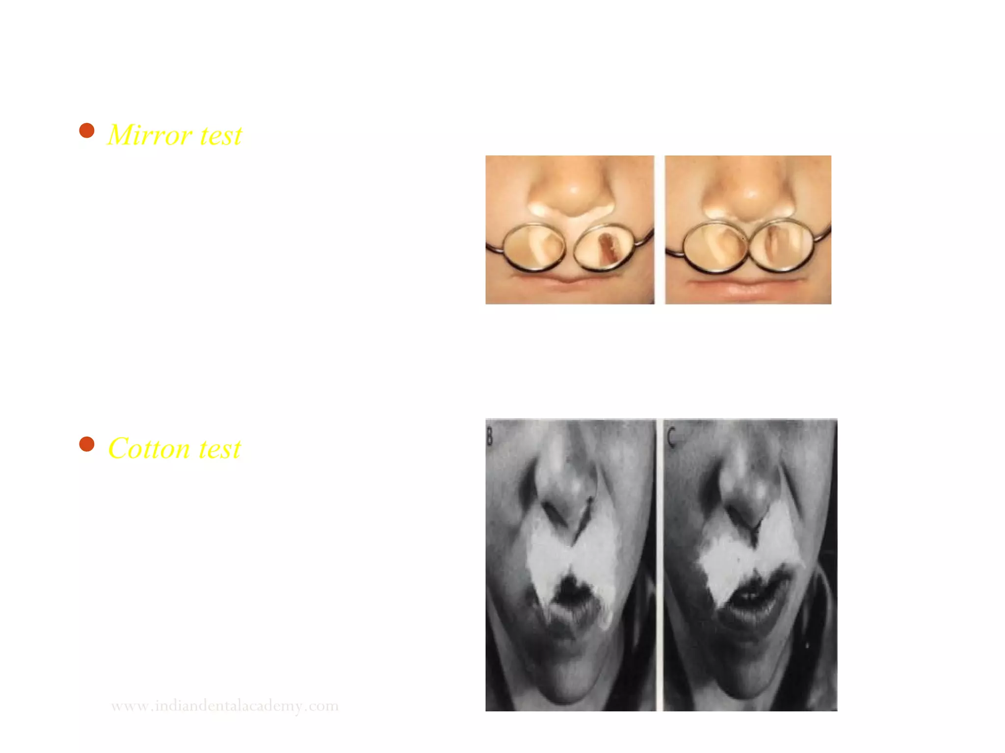 Mirror test
Cotton test
www.indiandentalacademy.com
 