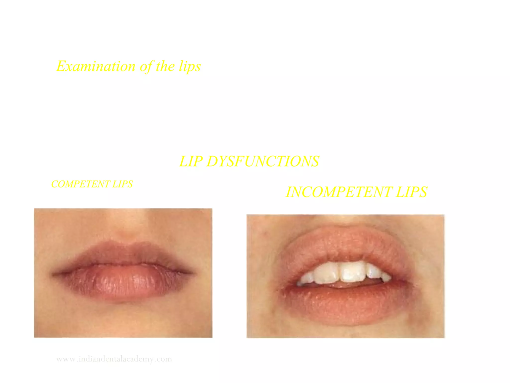 Examination of the lips
The lips must be carefully examined as a part of the functional
assessment. The lips should be examined at rest and during
swallow and mastication.
LIP DYSFUNCTIONS
COMPETENT LIPS
INCOMPETENT LIPS
www.indiandentalacademy.com
 