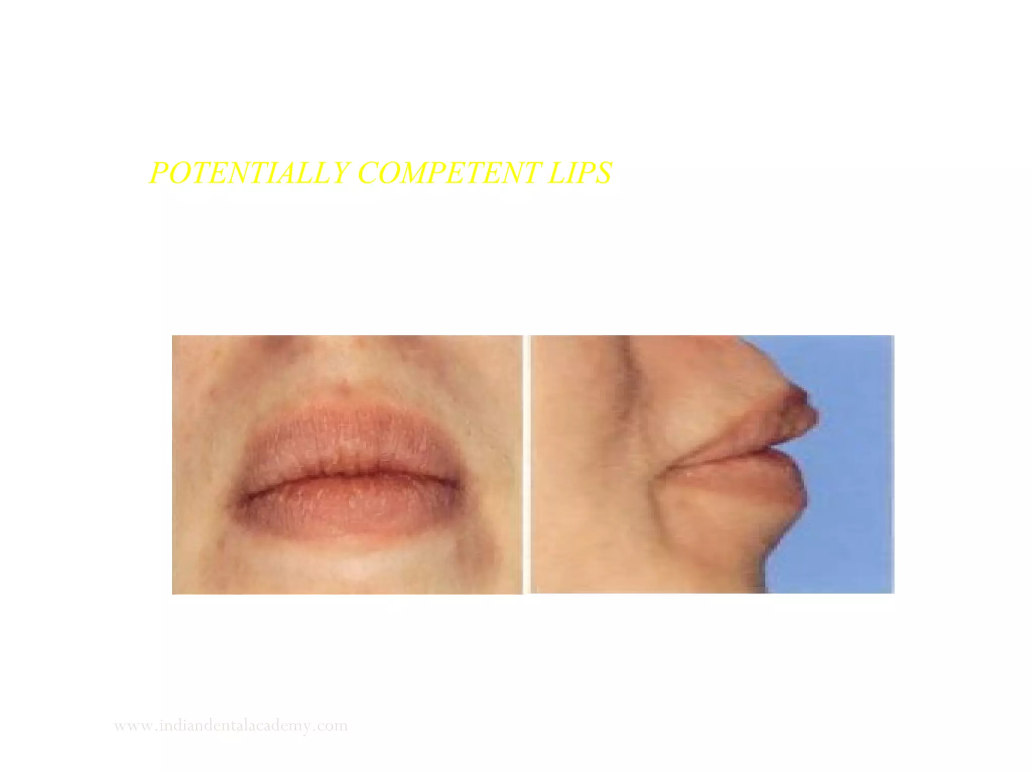 POTENTIALLY COMPETENT LIPS
www.indiandentalacademy.com
 