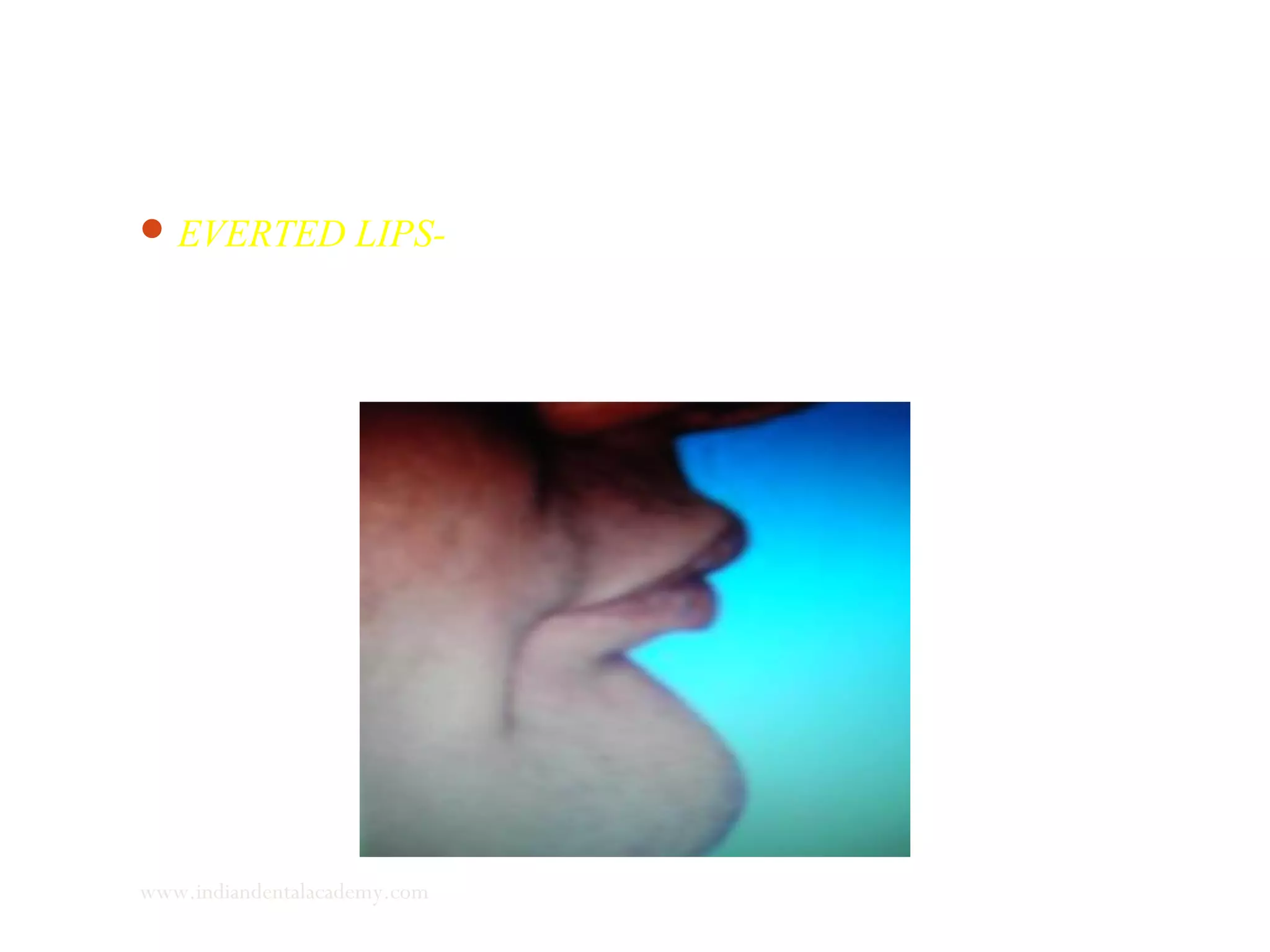 EVERTED LIPS- These are hypertrophied lips with redundant
tissue but weak muscular tonicity.
www.indiandentalacademy.com
 