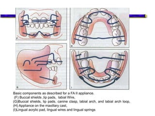 Basic components as described for a FA II appliance.
(F) Buccal shields ,lip pads, labial Wire,
(G)Buccal shields, lip pads, canine clasp, labial arch, and labial arch loop,
(H) Appliance on the maxillary cast,
(I)Lingual acrylic pad, lingual wires and lingual springs
 