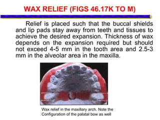 WAX RELIEF (FIGS 46.17K TO M)
Relief is placed such that the buccal shields
and lip pads stay away from teeth and tissues to
achieve the desired expansion. Thickness of wax
depends on the expansion required but should
not exceed 4-5 mm in the tooth area and 2.5-3
mm in the alveolar area in the maxilla.
Wax relief in the maxillary arch. Note the
Configuration of the palatal bow as well
 