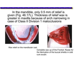 In the mandible, only 0.5 mm of relief is
given (Fig. 46.17L). Thickness of relief wax is
greater in maxilla because of arch narrowing in
case of Class II Division 1 malocclusions
Wax relief on the mandibular cast
Complete wax up of the Frankel. Ready for
the fabrication of the buccal shields in cold
cure acrylic
 