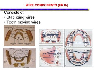 WIRE COMPONENTS (FR Ib)
Consists of:
• Stabilizing wires
• Tooth moving wires
 
