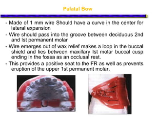 Palatal Bow
- Made of 1 mm wire Should have a curve in the center for
lateral expansion
- Wire should pass into the groove between deciduous 2nd
and Ist permanent molar
- Wire emerges out of wax relief makes a loop in the buccal
shield and lies between maxillary Ist molar buccal cusp
ending in the fossa as an occlusal rest.
- This provides a positive seat to the FR as well as prevents
eruption of the upper 1st permanent molar.
 